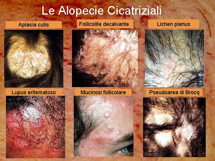 Le Alopecie Cicatriziali Aplasìa cutis Follicolite decalvante Lichen planus Lupus eritematoso Mucinosi follicolare Pseudoarea