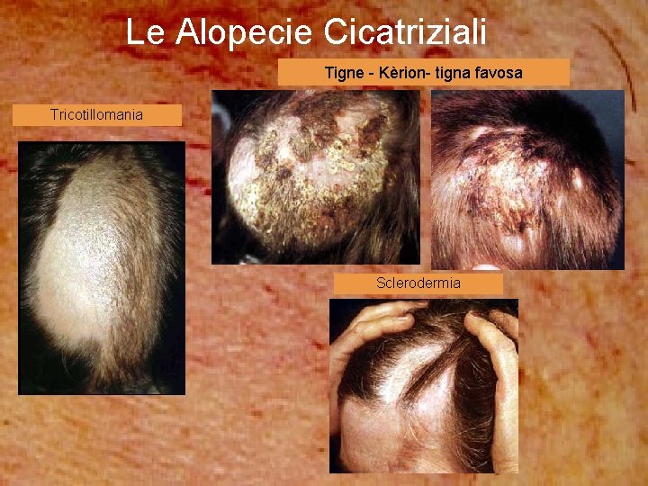 Le Alopecie Cicatriziali Tigne - Kèrion- tigna favosa Tricotillomania Sclerodermia 