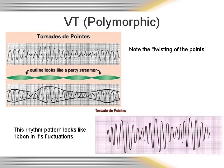 VT (Polymorphic) Note the “twisting of the points” This rhythm pattern looks like ribbon