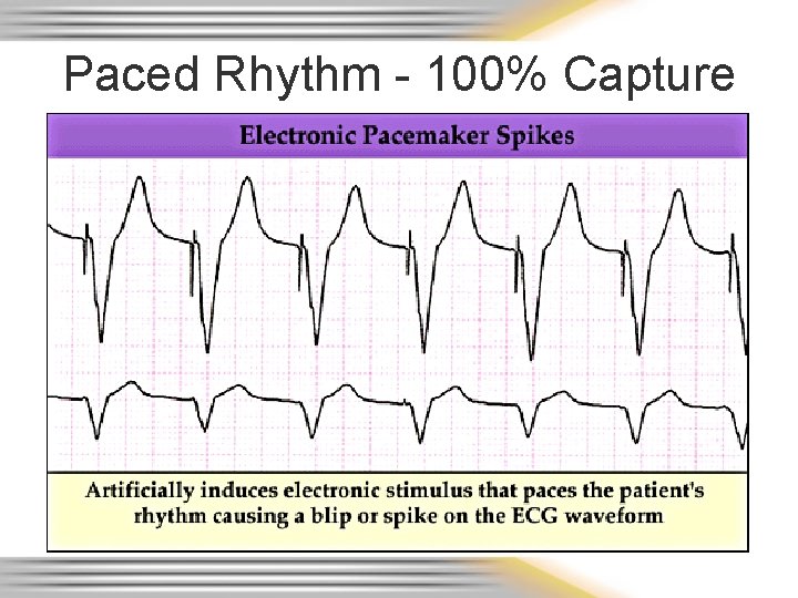Paced Rhythm - 100% Capture 