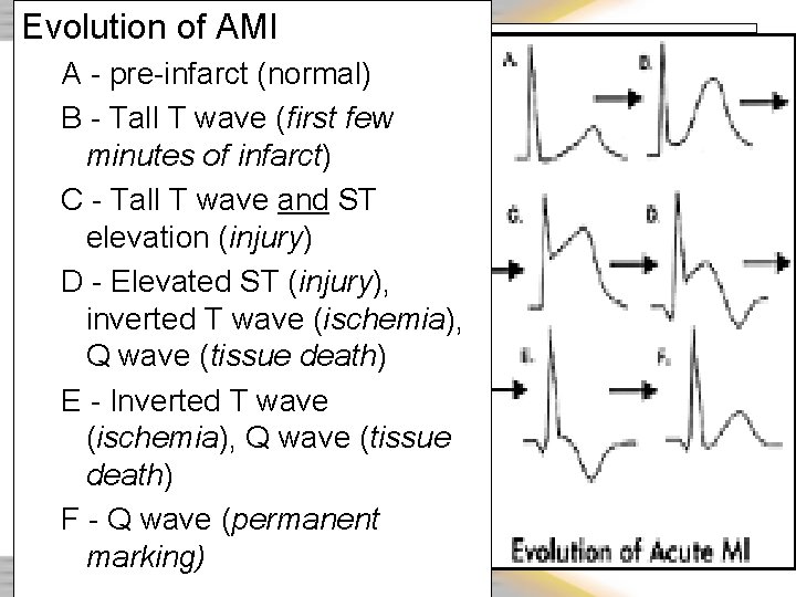 Evolution of AMI A - pre-infarct (normal) B - Tall T wave (first few