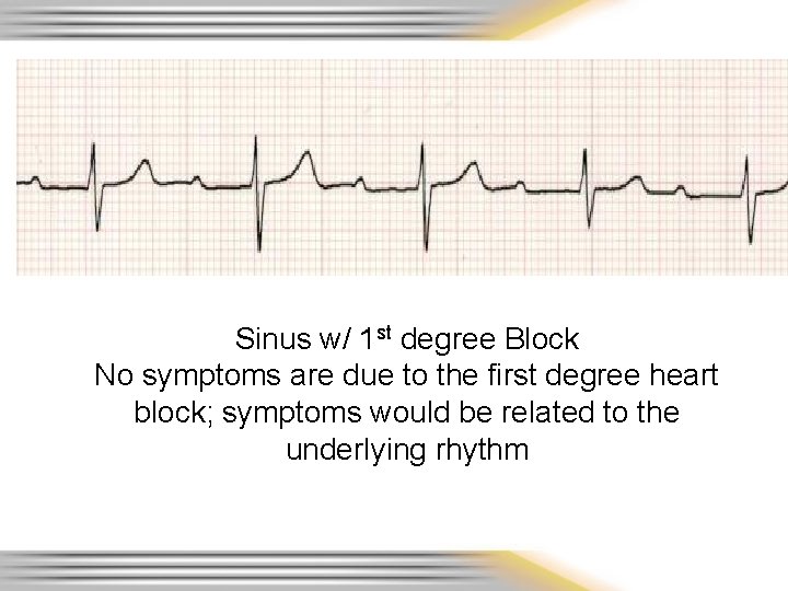Sinus w/ 1 st degree Block No symptoms are due to the first degree