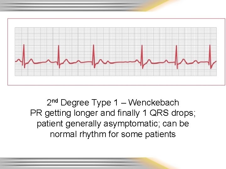 2 nd Degree Type 1 – Wenckebach PR getting longer and finally 1 QRS