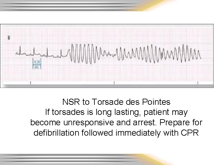 NSR to Torsade des Pointes If torsades is long lasting, patient may become unresponsive
