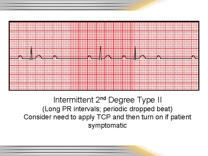 Intermittent 2 nd Degree Type II (Long PR intervals; periodic dropped beat) Consider need