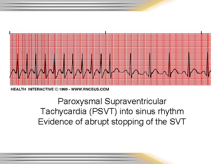 Paroxysmal Supraventricular Tachycardia (PSVT) into sinus rhythm Evidence of abrupt stopping of the SVT