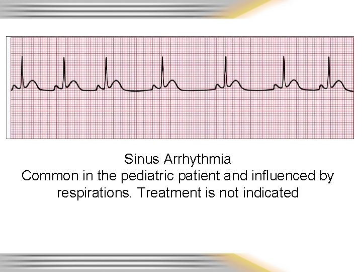 Sinus Arrhythmia Common in the pediatric patient and influenced by respirations. Treatment is not