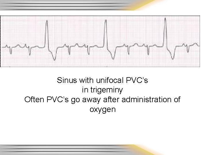 Sinus with unifocal PVC’s in trigeminy Often PVC’s go away after administration of oxygen