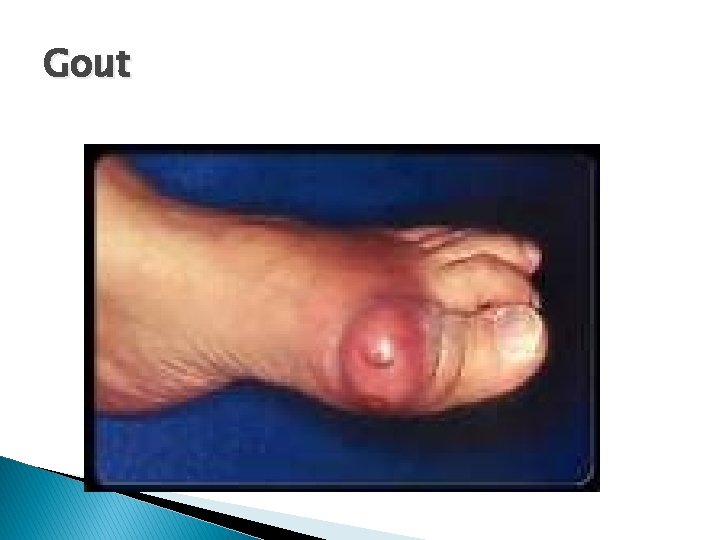Gout 