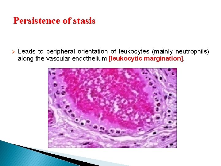 Persistence of stasis Ø Leads to peripheral orientation of leukocytes (mainly neutrophils) along the