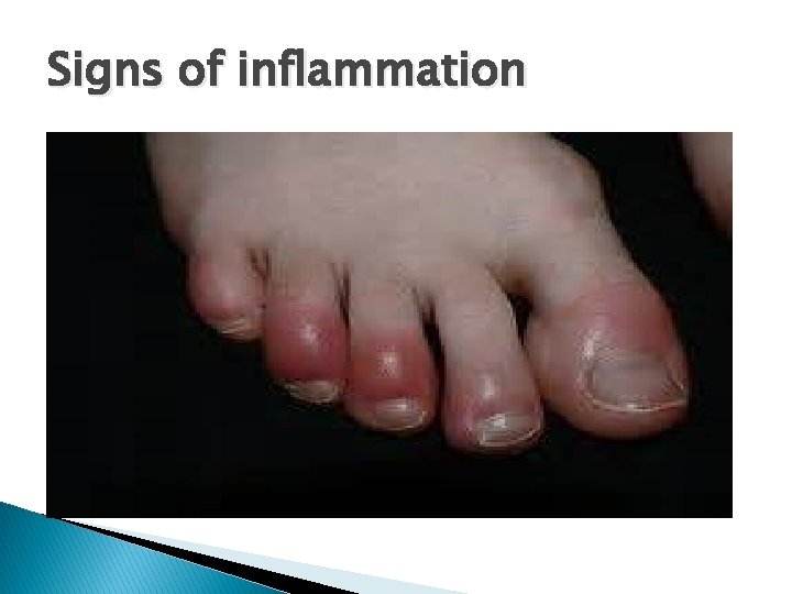 Signs of inflammation 