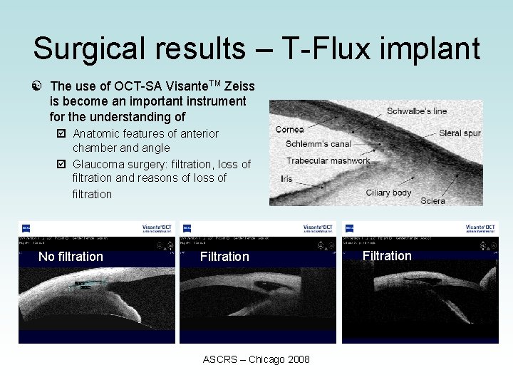 Surgical results – T-Flux implant [ The use of OCT-SA Visante. TM Zeiss is