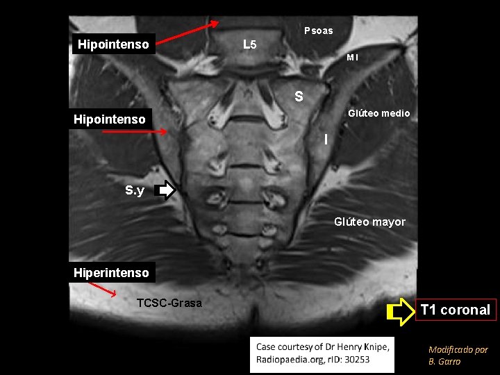 Psoas Hipointenso L 5 MI S Glúteo medio Hipointenso I S. y Glúteo mayor