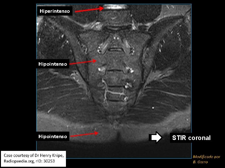 Hiperintenso Hipointenso STIR coronal 