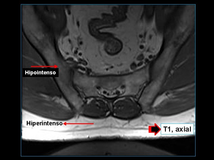 Hipointenso Hiperintenso T 1, axial 