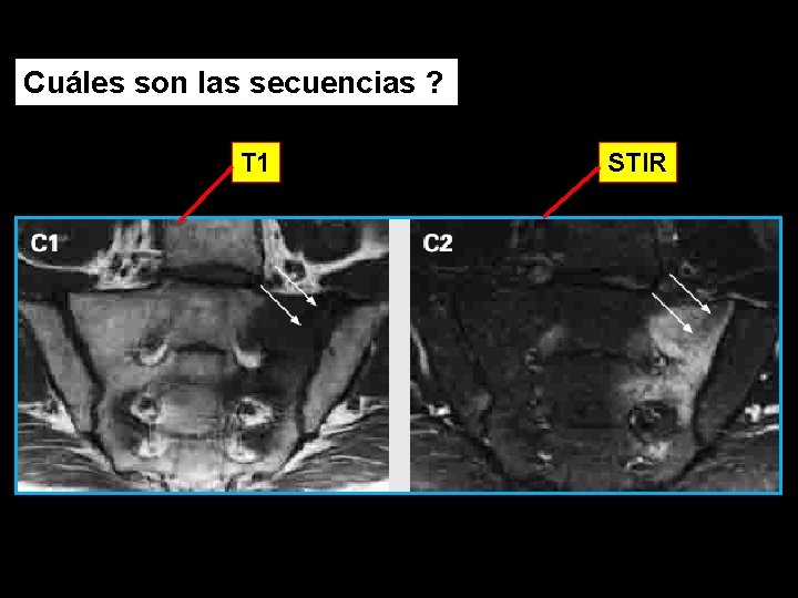 Cuáles son las secuencias ? T 1 STIR 