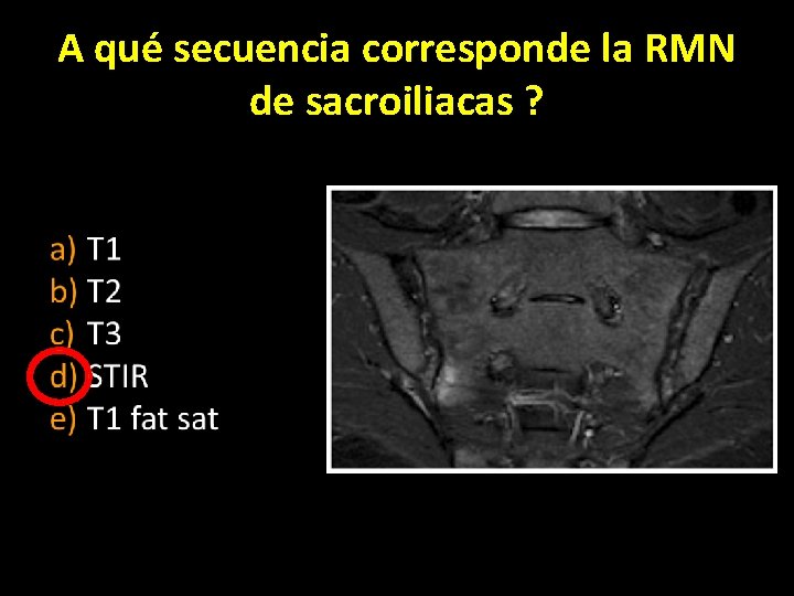 A qué secuencia corresponde la RMN de sacroiliacas ? 