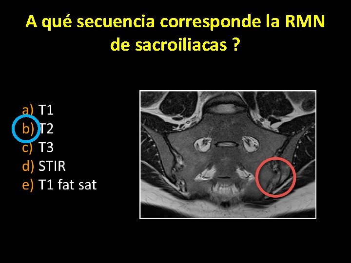 A qué secuencia corresponde la RMN de sacroiliacas ? 