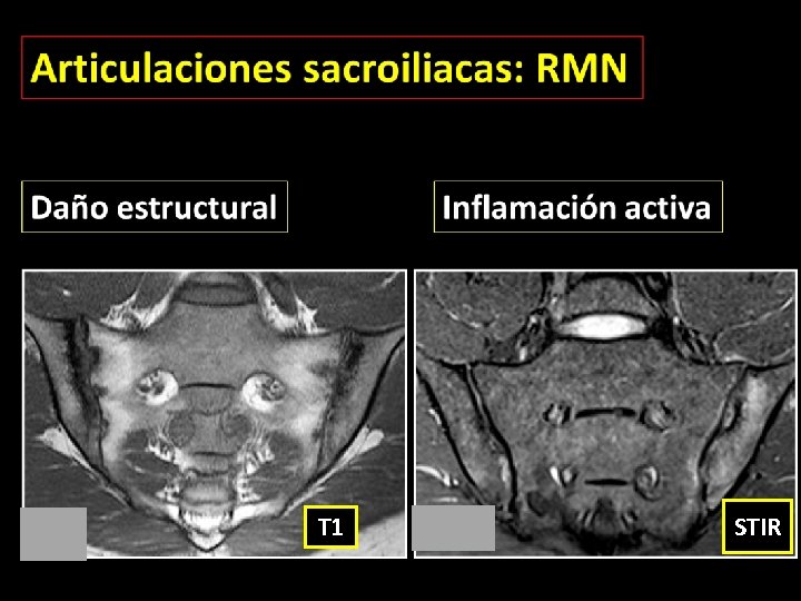 T 1 STIR 