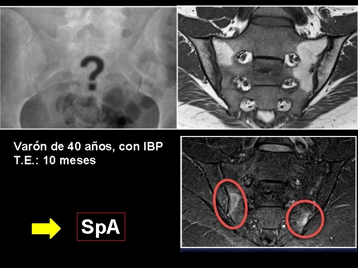 Varón de 40 años, con IBP T. E. : 10 meses Sp. A 