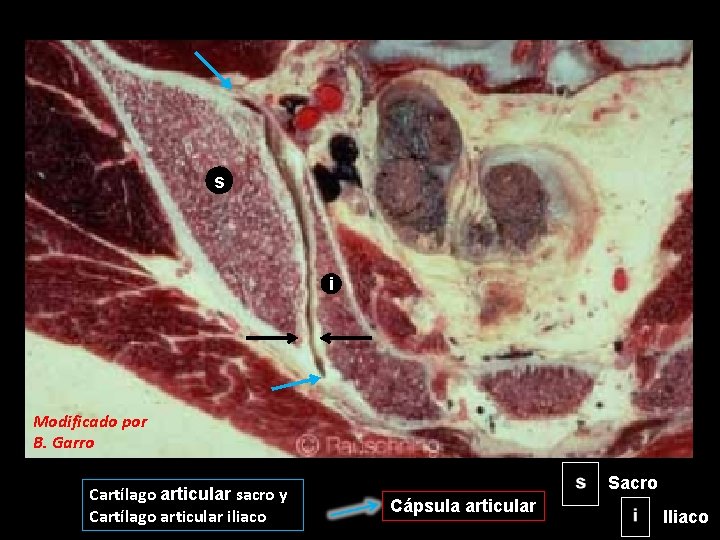 s i Modificado por B. Garro Cartílago articular sacro y Cartílago articular iliaco Sacro