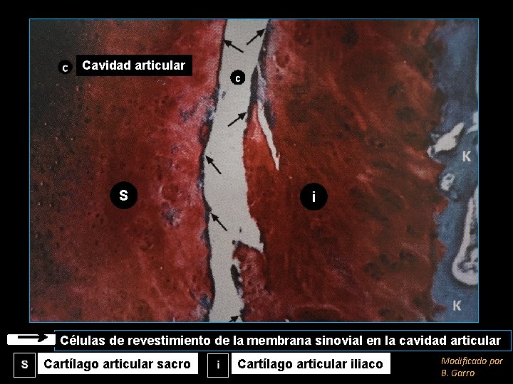 Cavidad articular S c i Células de revestimiento de la membrana sinovial en la