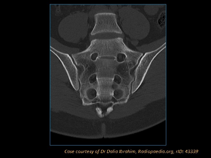 Case courtesy of Dr Dalia Ibrahim, Radiopaedia. org, r. ID: 43339 