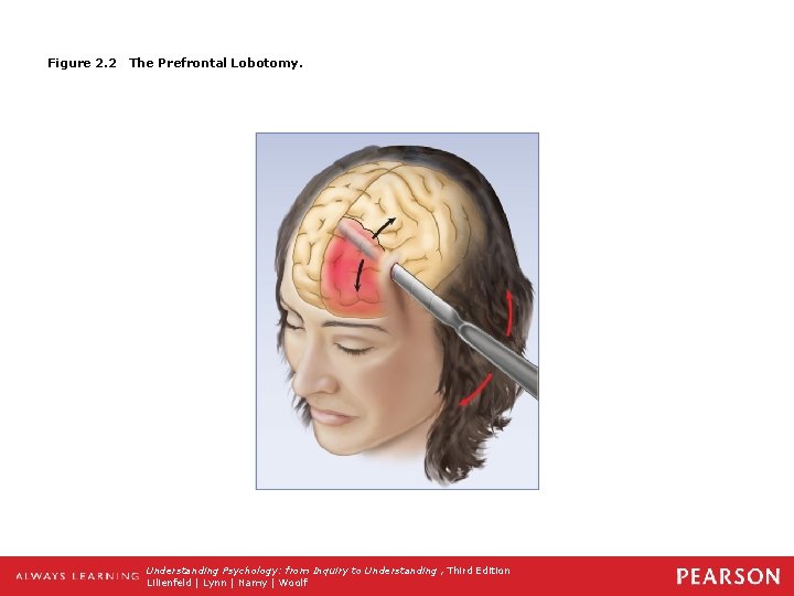 Figure 2. 2 The Prefrontal Lobotomy. Understanding Psychology: from Inquiry to Understanding , Third