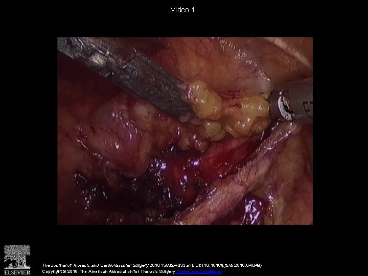 Video 1 The Journal of Thoracic and Cardiovascular Surgery 2018 156824 -833. e 1