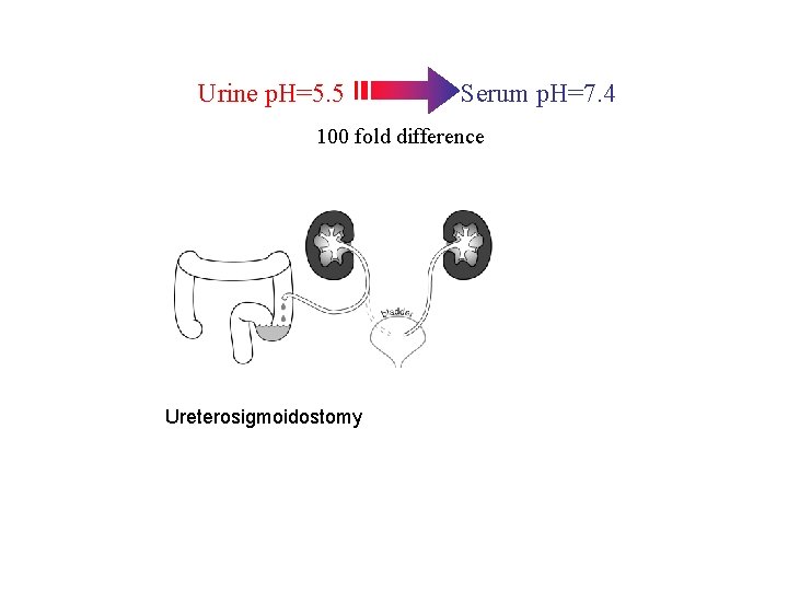 Urine p. H=5. 5 Serum p. H=7. 4 100 fold difference Ureterosigmoidostomy 