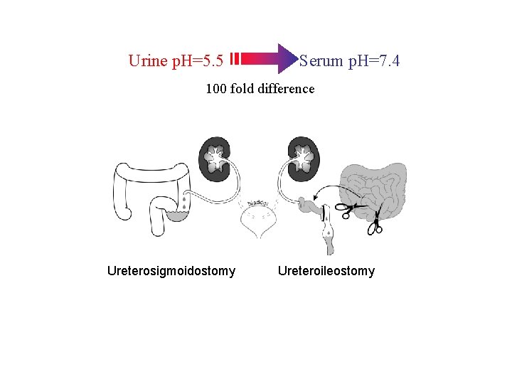 Urine p. H=5. 5 Serum p. H=7. 4 100 fold difference Ureterosigmoidostomy Ureteroileostomy 