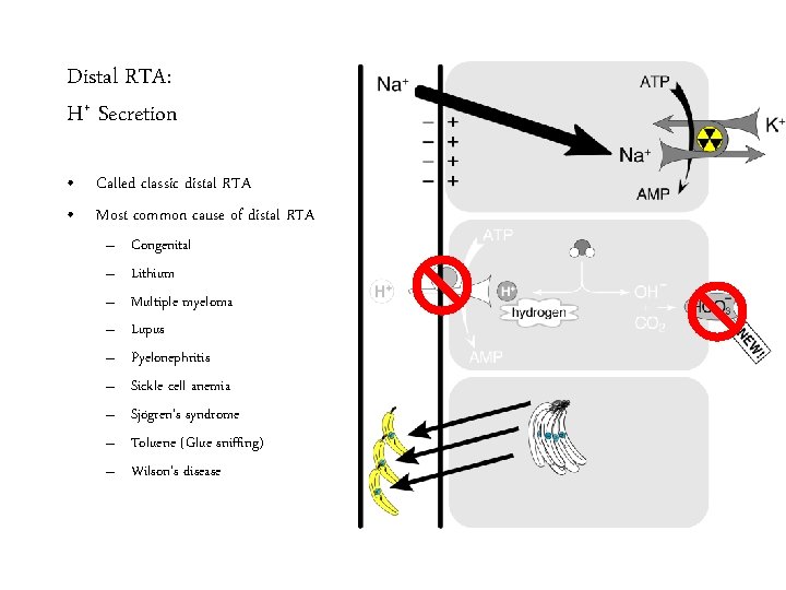 Distal RTA: H+ Secretion • Called classic distal RTA • Most common cause of