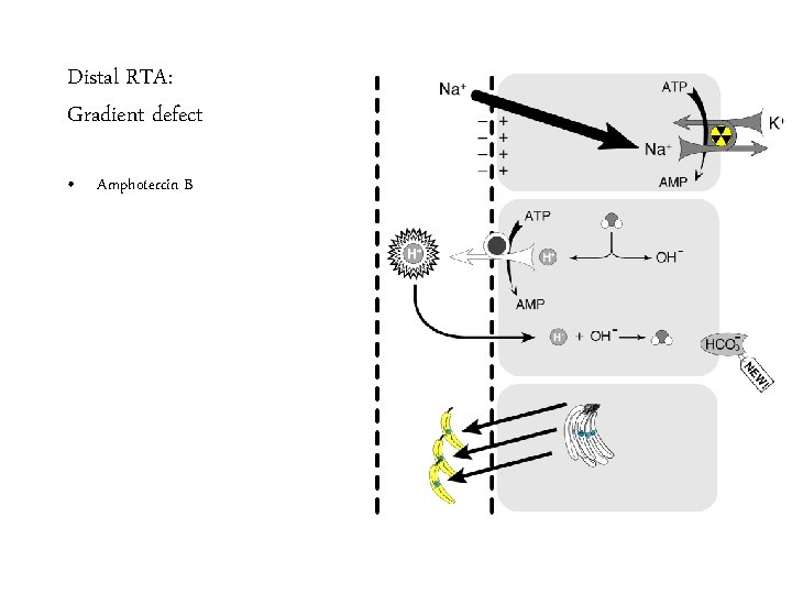 Distal RTA: Gradient defect • Amphotercin B 