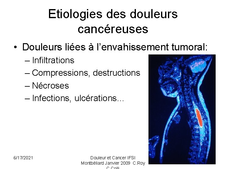 Etiologies douleurs cancéreuses • Douleurs liées à l’envahissement tumoral: – Infiltrations – Compressions, destructions