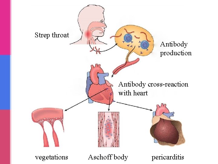 Strep throat Antibody production Antibody cross-reaction with heart vegetations Aschoff body pericarditis Strep throat Antibody production Antibody cross-reaction with heart vegetations Aschoff body pericarditis