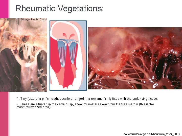 Rheumatic Vegetations: 1. Tiny (size of a pin’s head), sessile arranged in a row Rheumatic Vegetations: 1. Tiny (size of a pin’s head), sessile arranged in a row