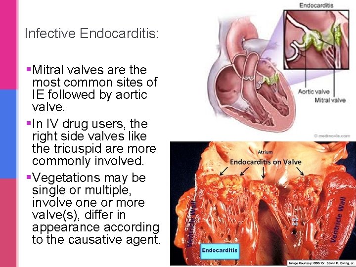 Infective Endocarditis: § Mitral valves are the most common sites of IE followed by Infective Endocarditis: § Mitral valves are the most common sites of IE followed by
