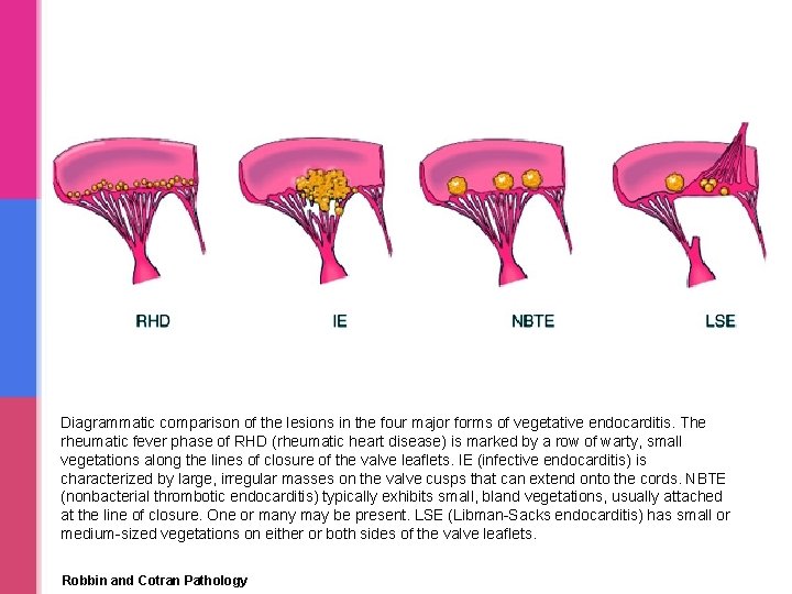 Diagrammatic comparison of the lesions in the four major forms of vegetative endocarditis. The Diagrammatic comparison of the lesions in the four major forms of vegetative endocarditis. The