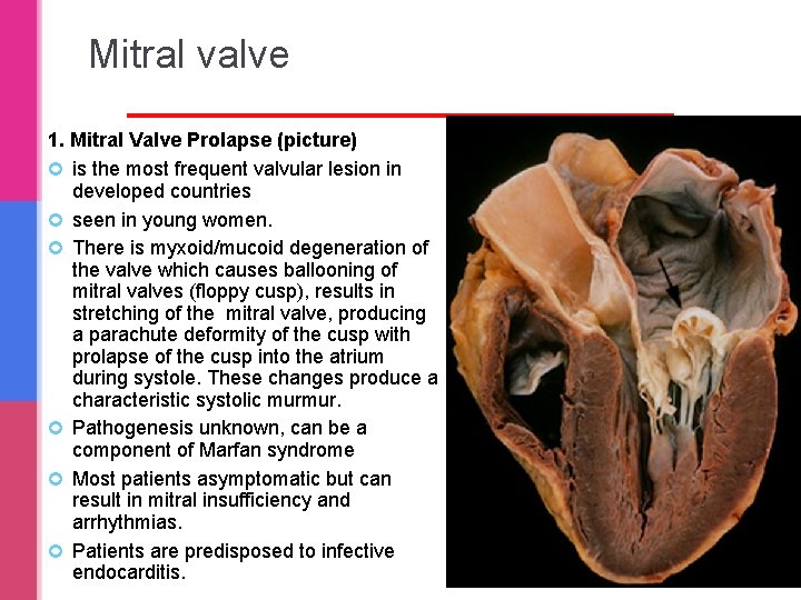 Mitral valve 1. Mitral Valve Prolapse (picture) is the most frequent valvular lesion in Mitral valve 1. Mitral Valve Prolapse (picture) is the most frequent valvular lesion in