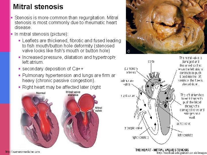 Mitral stenosis § Stenosis is more common than regurgitation. Mitral stenosis is most commonly Mitral stenosis § Stenosis is more common than regurgitation. Mitral stenosis is most commonly