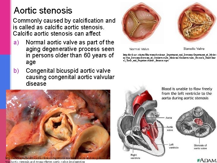 Aortic stenosis Commonly caused by calcification and is called as calcific aortic stenosis. Calcific Aortic stenosis Commonly caused by calcification and is called as calcific aortic stenosis. Calcific