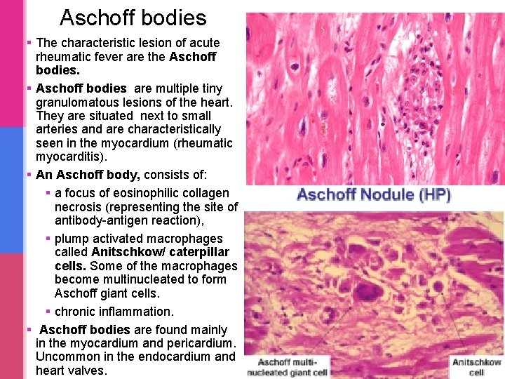 Aschoff bodies § The characteristic lesion of acute rheumatic fever are the Aschoff bodies. Aschoff bodies § The characteristic lesion of acute rheumatic fever are the Aschoff bodies.