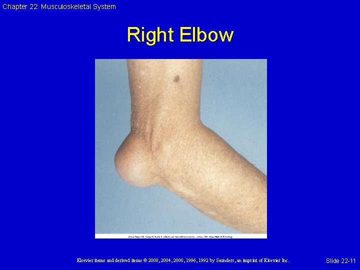 Chapter 22: Musculoskeletal System Right Elbow Elsevier items and derived items © 2008, 2004,