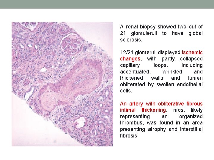 A renal biopsy showed two out of 21 glomuleruli to have global sclerosis. 12/21 A renal biopsy showed two out of 21 glomuleruli to have global sclerosis. 12/21
