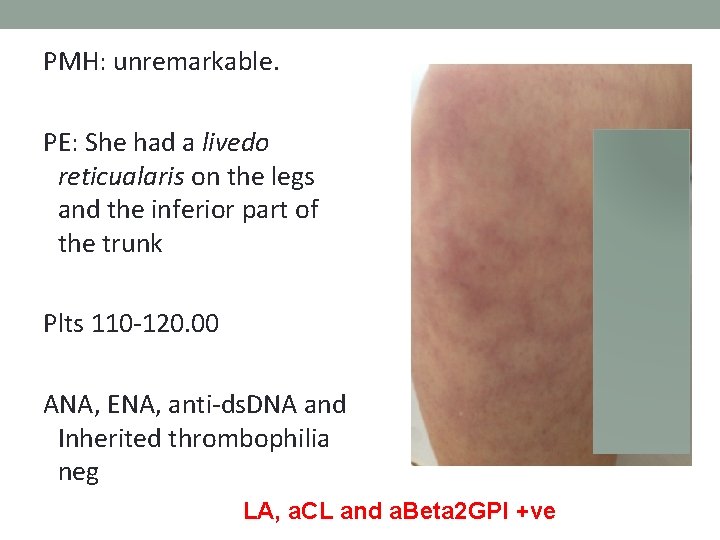 PMH: unremarkable. PE: She had a livedo reticualaris on the legs and the inferior PMH: unremarkable. PE: She had a livedo reticualaris on the legs and the inferior
