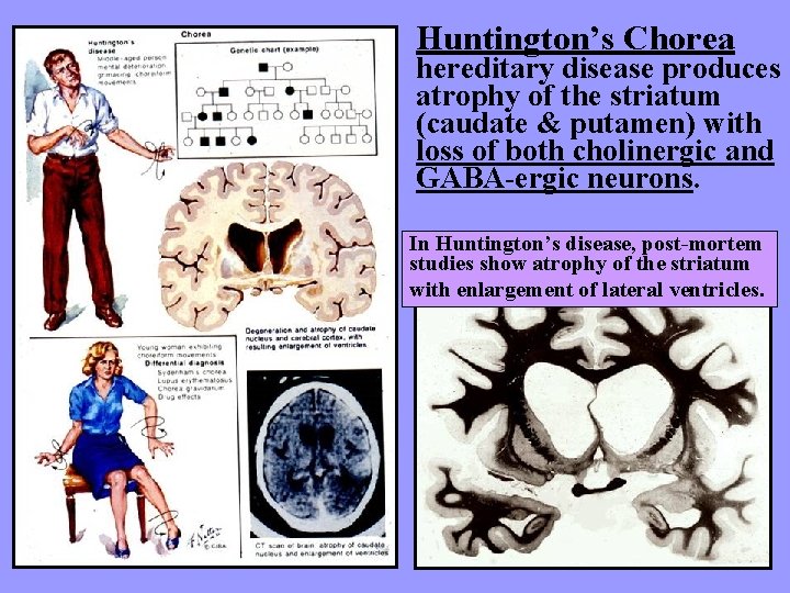 Huntington’s Chorea hereditary disease produces atrophy of the striatum (caudate & putamen) with loss