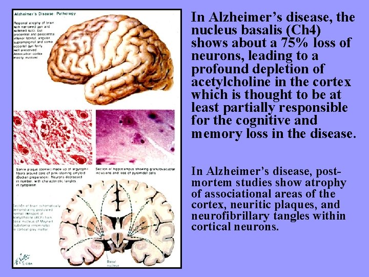 In Alzheimer’s disease, the nucleus basalis (Ch 4) shows about a 75% loss of