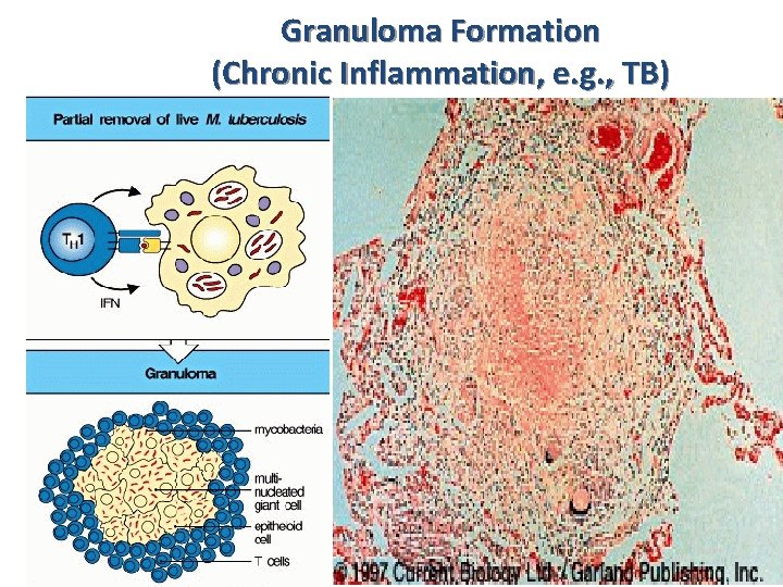 Granuloma Formation (Chronic Inflammation, e. g. , TB) 
