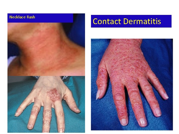 Necklace Rash Contact Dermatitis 