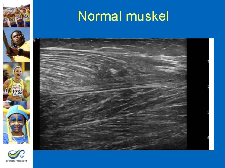 Normal muskel 